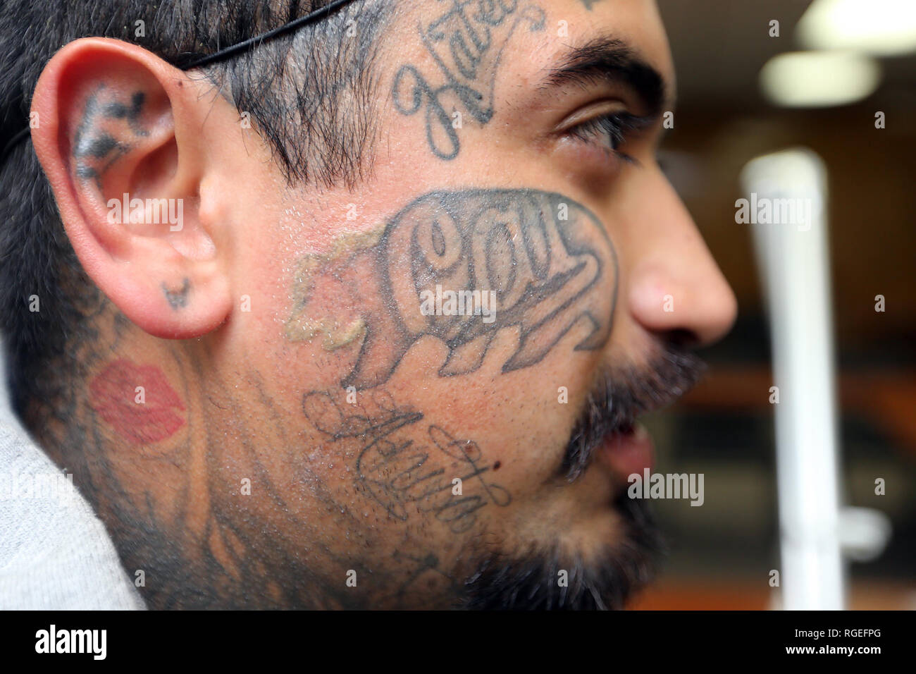 February 26, 2018 - Napa, CA, U.S. - Jose De La Cruz prepares to have this bear tattoo removed from his face by Dr. William McClure of Napa Valley Plastic Surgery. The Napa County Probation Department has reinstated the tattoo removal program after a two-year hiatus. (Credit Image: © Napa Valley Register via ZUMA Wire) Stock Photo