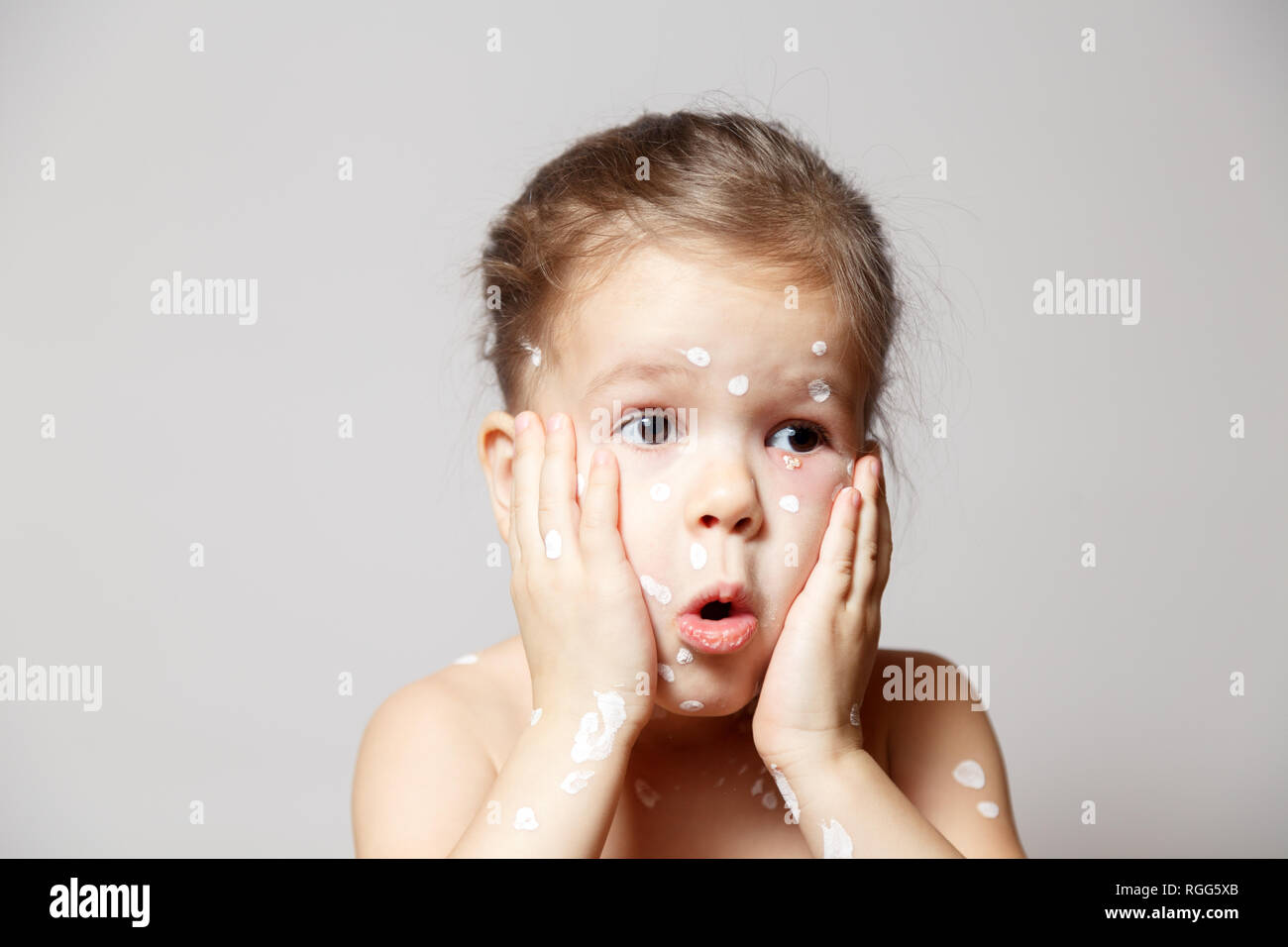 Child With Chicken Pox Spots On Face And Calamine Lotion Stock Photo Alamy