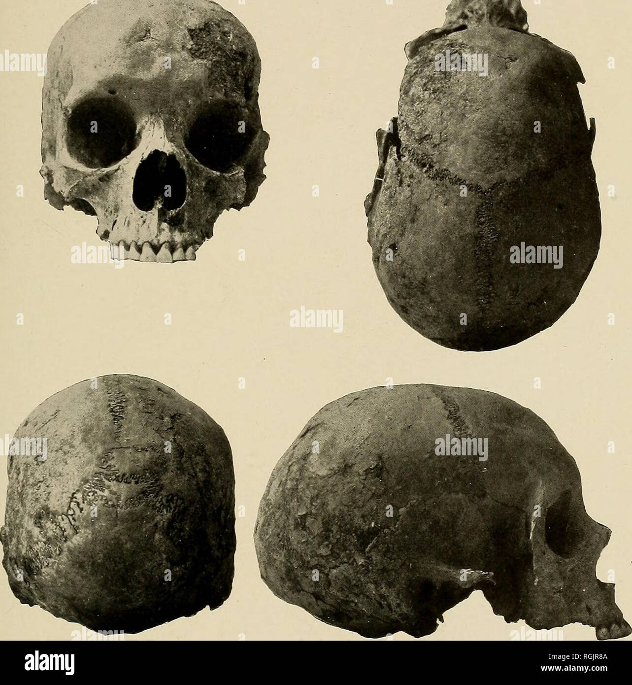 . Bulletin - New York State Museum. Science. iPlate 17. Four views of an adult female cranium from grave XCII. Note, Y-shaped lesion in frontalis, see front view^ ; doiichocephaly shown in top view ; wor- mian bones and sutural formation in back view ; small alesphenoid and facial angle in side view. Please note that these images are extracted from scanned page images that may have been digitally enhanced for readability - coloration and appearance of these illustrations may not perfectly resemble the original work.. New York State Museum; New York State Museum. Albany : New York State Educati Stock Photo