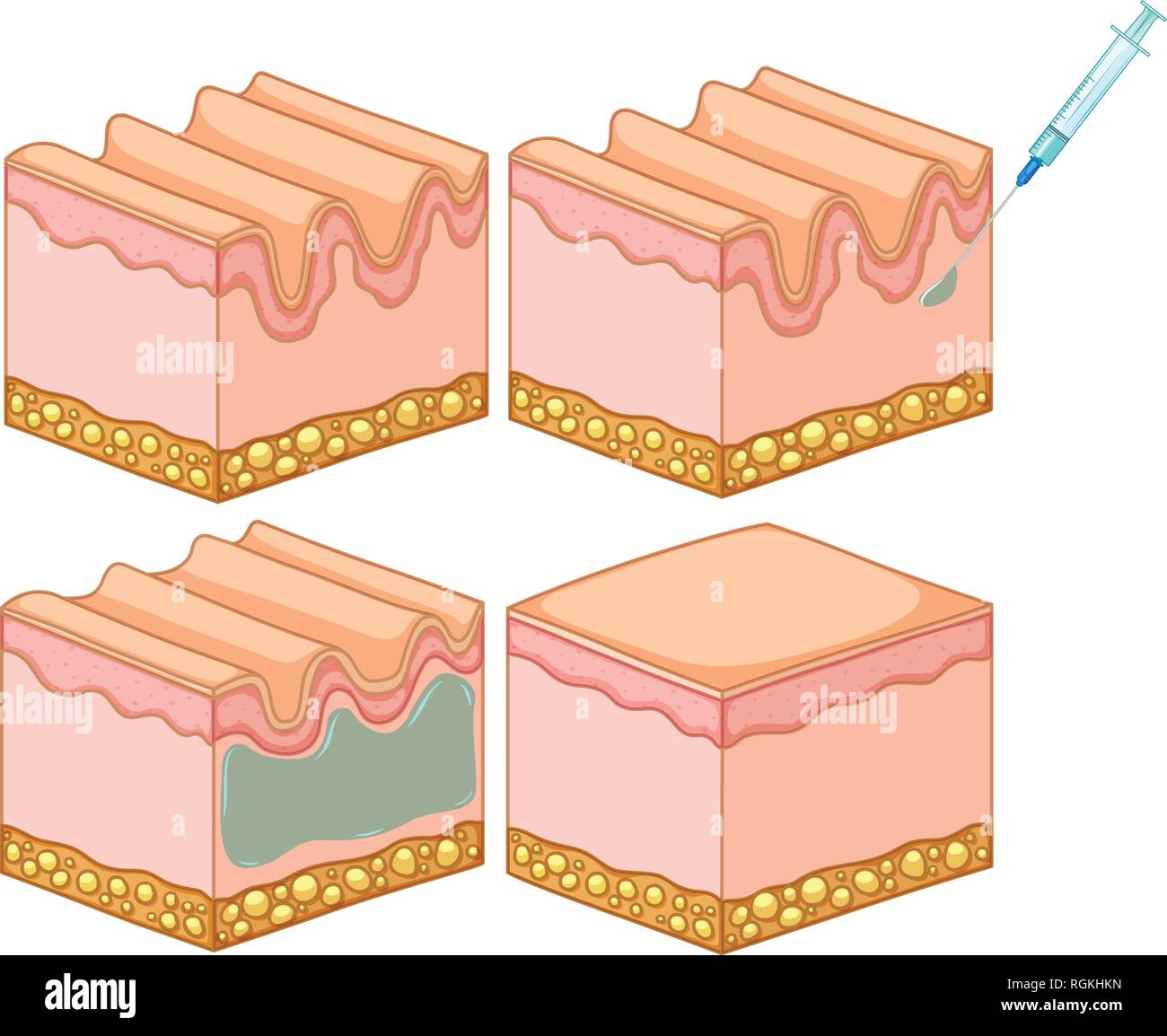 Botox injection vector hi-res stock photography and images - Alamy