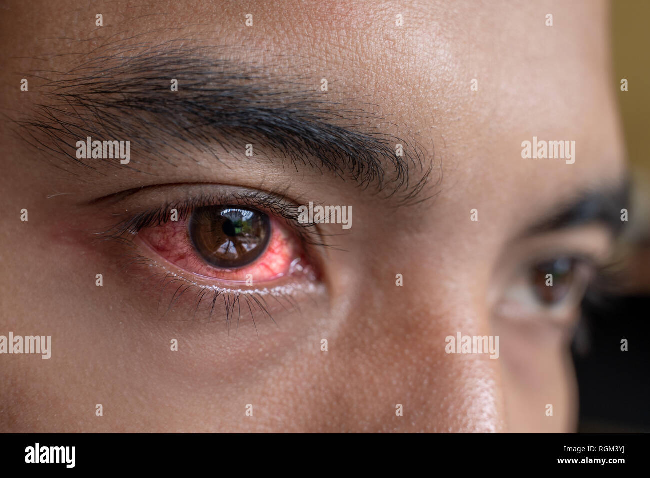 irritated red eyes need sterile eye drops Stock Photo Alamy