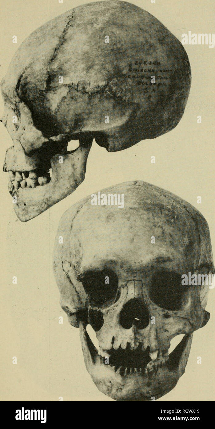 . Bulletin. Ethnology. Plate 5.—Skull from Cerro Tablayo, Colombia (lateralis and frontalis). Com- pare the small features with those of skull shown in plate 6, and note the low vault. Mean height index is 73.6. (Courtesy United States National Museum, skull No. 298,343.). Please note that these images are extracted from scanned page images that may have been digitally enhanced for readability - coloration and appearance of these illustrations may not perfectly resemble the original work.. Smithsonian Institution. Bureau of American Ethnology. Washington : G. P. O. Stock Photo