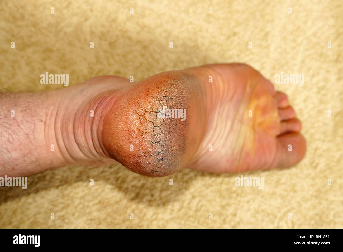 Deep cracks in feet discount
