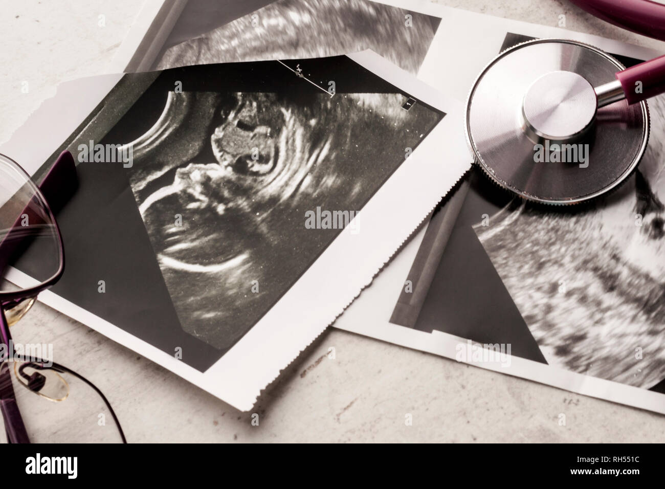 Phonendoscope vs stethoscope and glasses lie on ultrasound images of