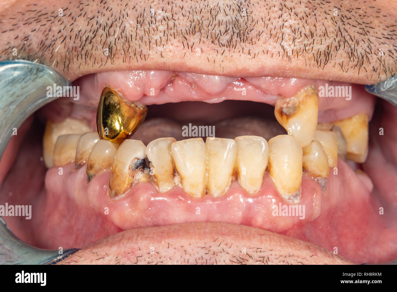 Dental caries. Filling with dental composite photopolymer material using rabbders. The concept of dental treatment in a dental clinic Stock Photo