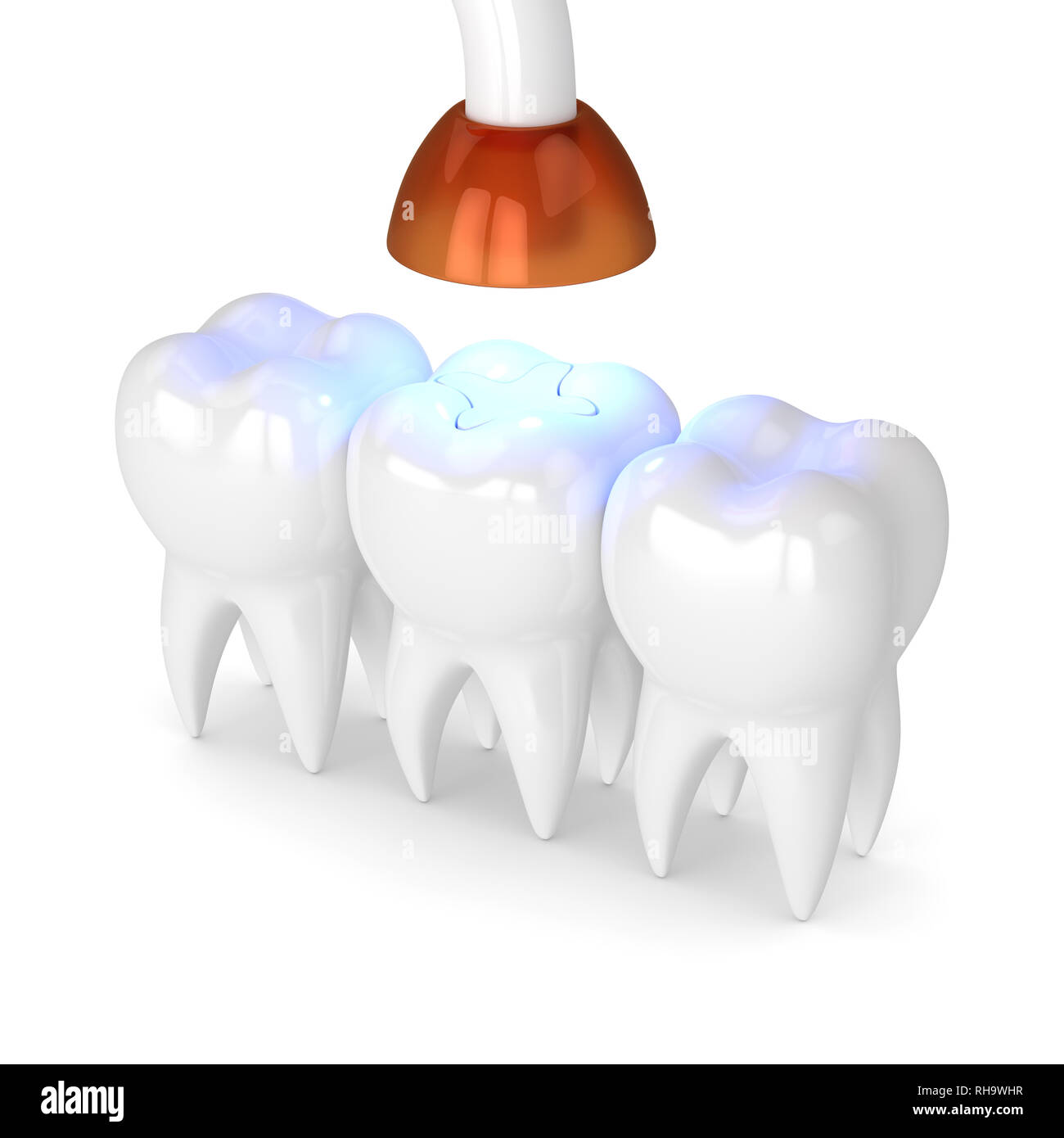 3d render of teeth with dental polymerization lamp and light cured inlay filling over white