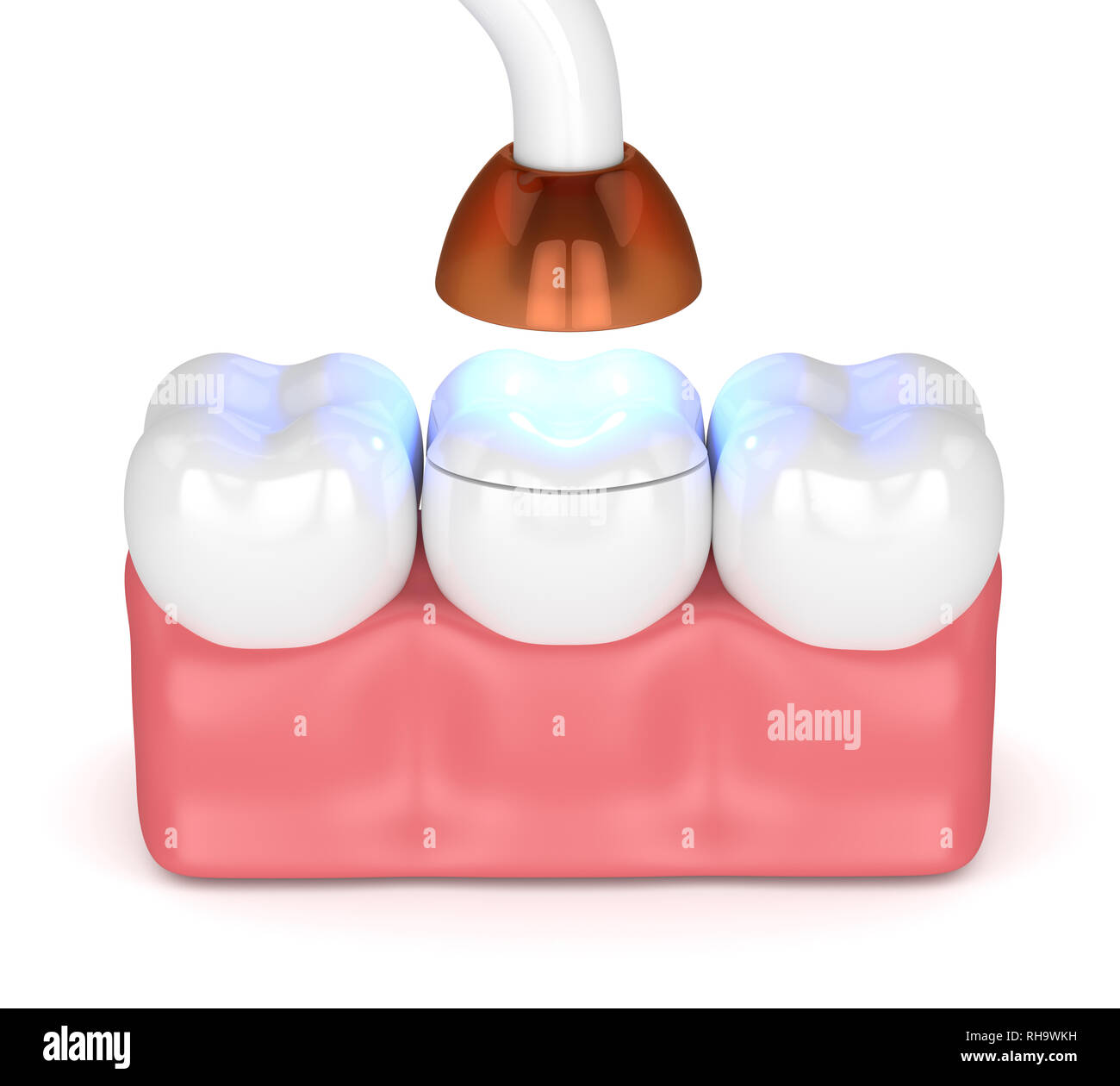 3d render of teeth with dental polymerization lamp and light cured
