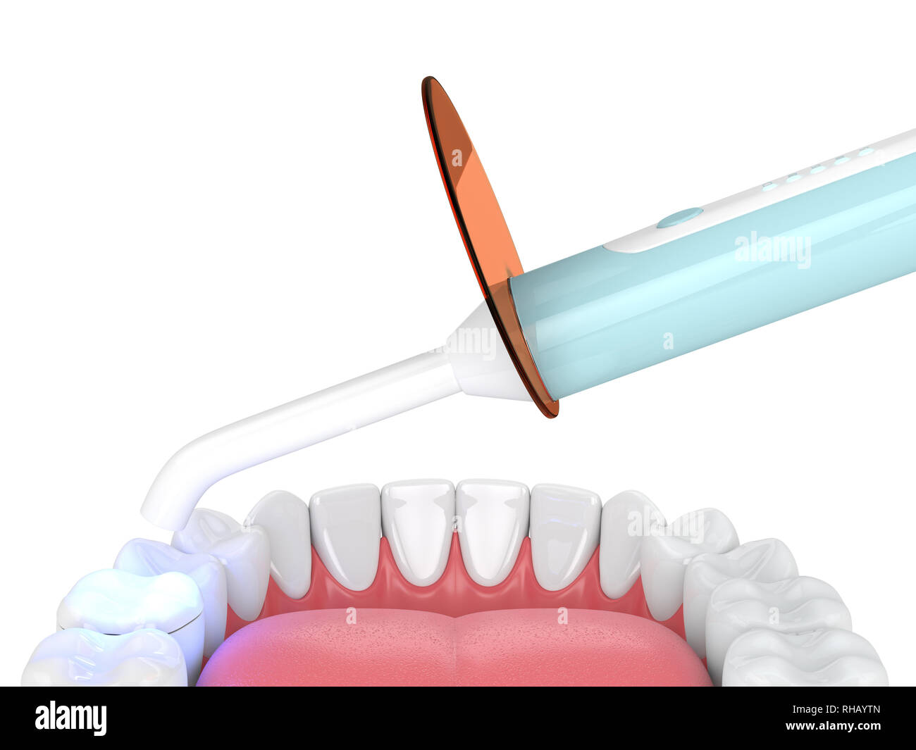 3d render of jaw with dental polymerization lamp and light cured onlay