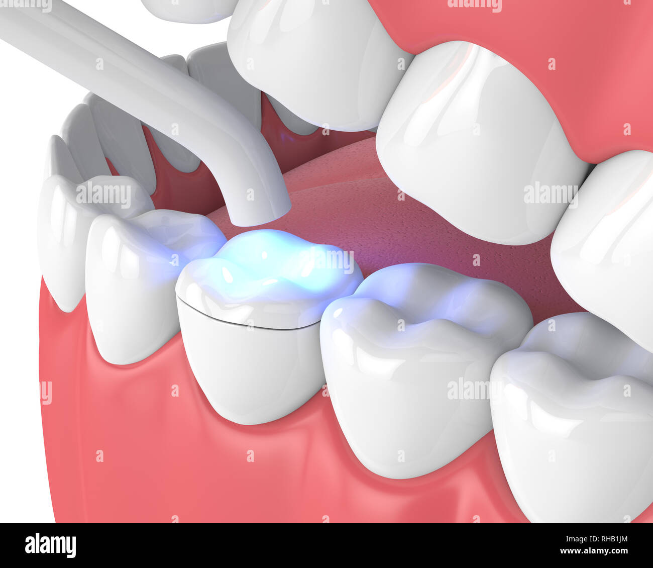 3d render of jaw with dental polymerization lamp and light cured onlay