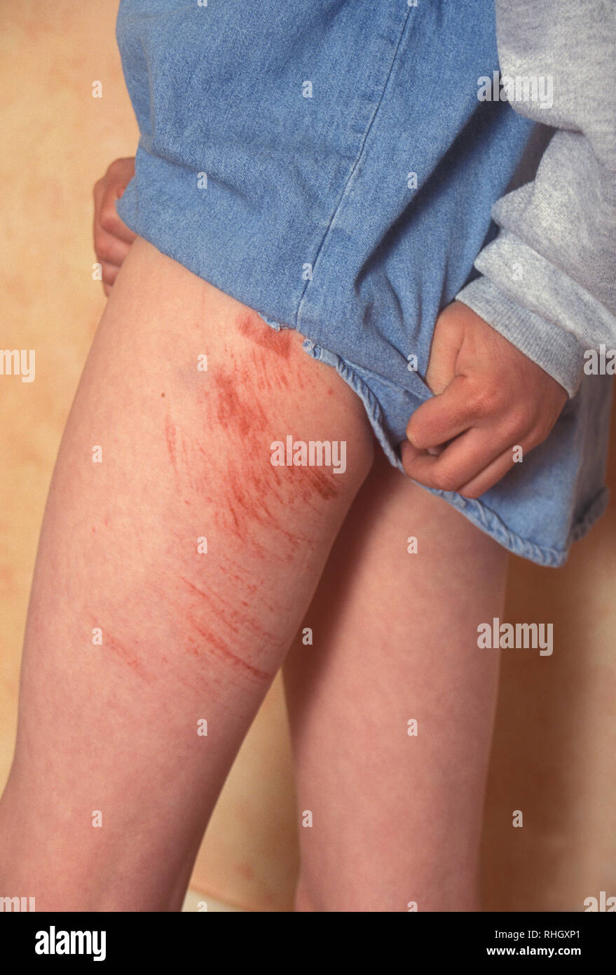 young boy with badly grazed leg Stock Photo - Alamy