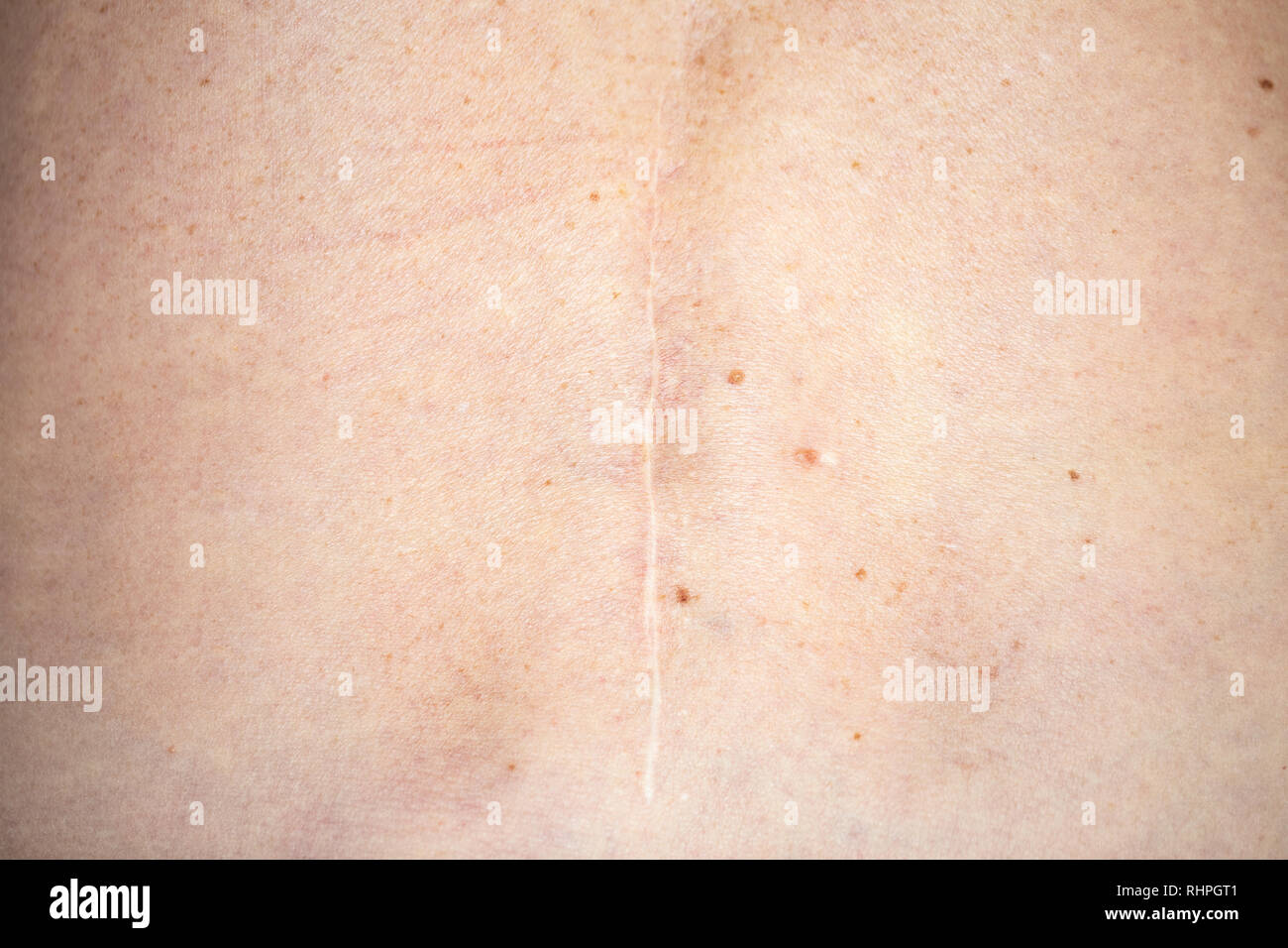 Scar on the back of an old caucasian woman after a spinal stenosis surgery Stock Photo
