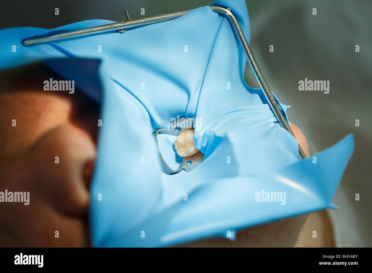 Patient getting dental treatment at dentist office with dental rubber dam protection and smart matrix system clamp, preventing saliva contamination. D Stock Photo