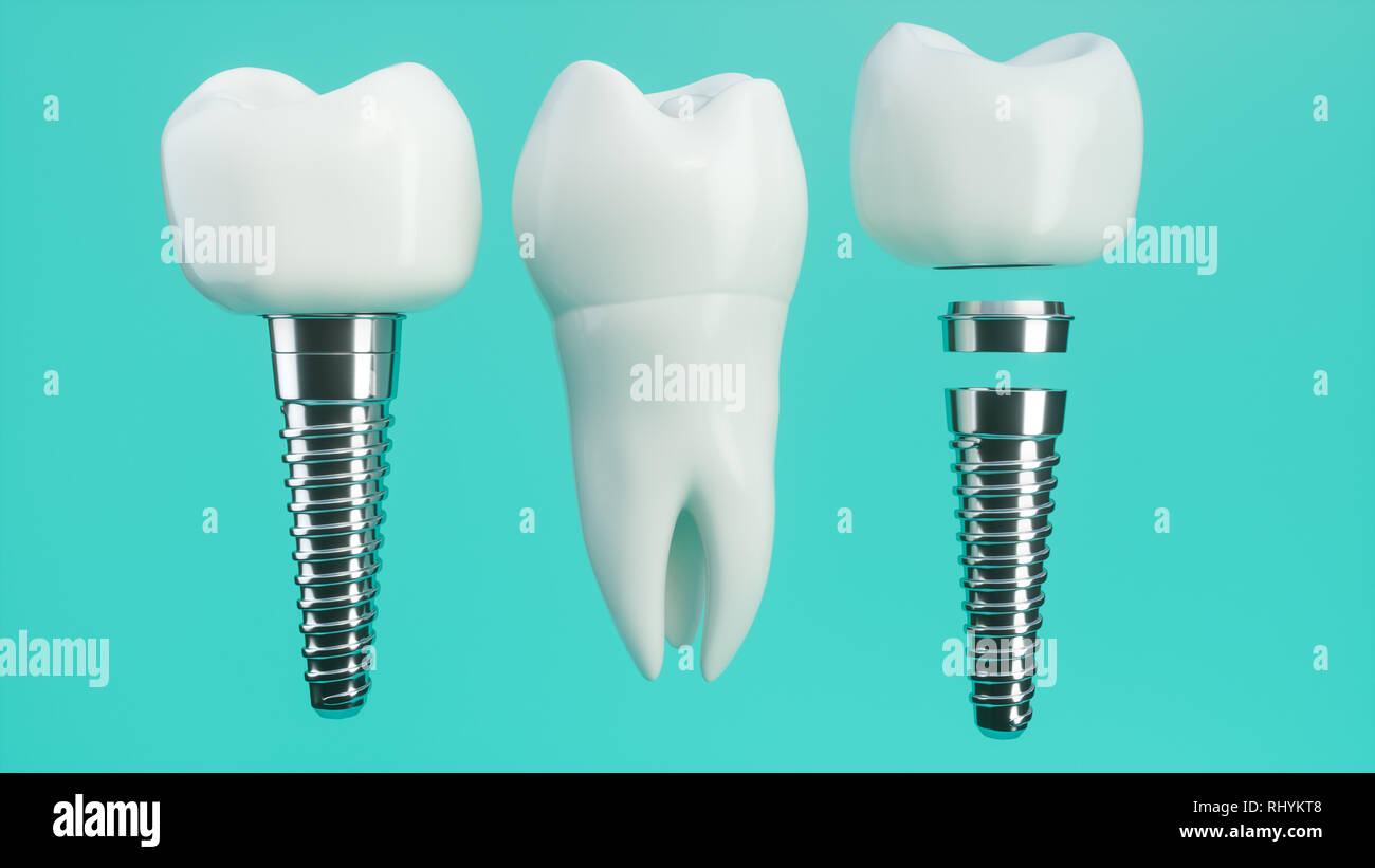 Tooth implant disassembled -- 3D Rendering Stock Photo