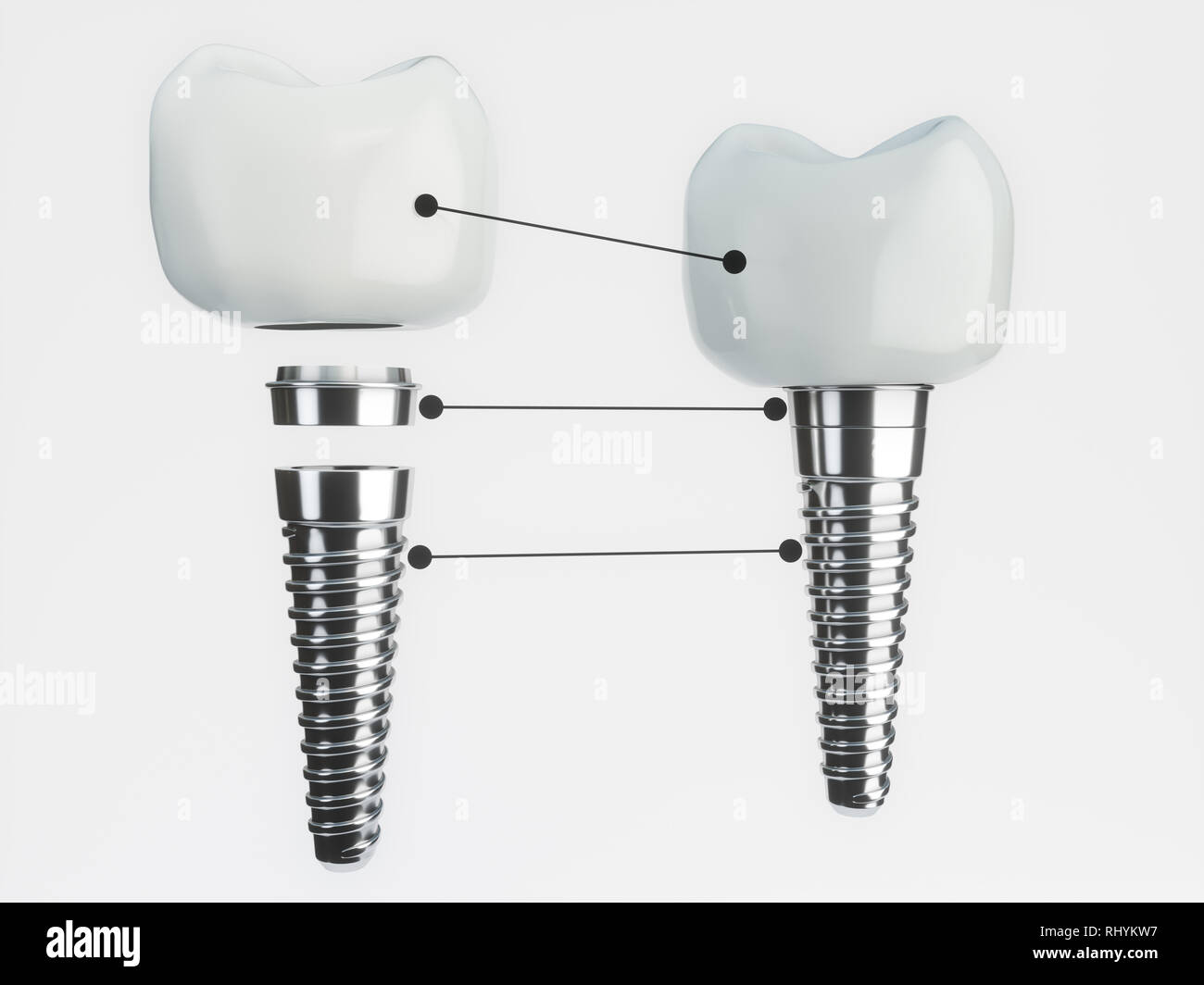Tooth implant disassembled - 3D Rendering Stock Photo