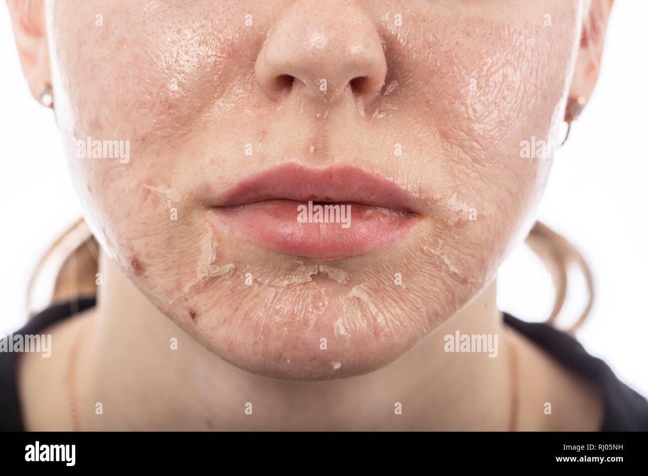 female face with burned skin after chemical peeling Stock Photo Alamy