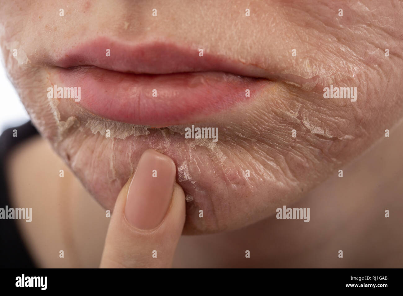 female face with burned skin after chemical peeling Stock Photo Alamy