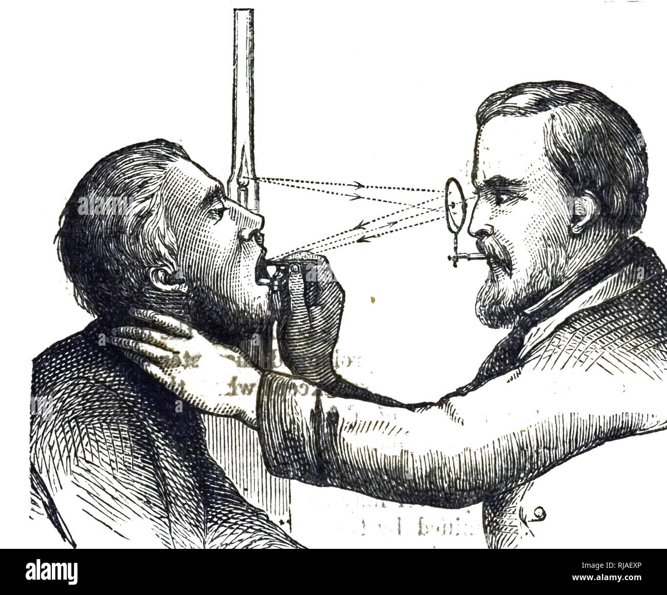 An engraving depicting Johann Nepomuk Czermak's laryngoscope used to perform a laryngoscopy, an endoscopy of the larynx.  Johann Nepomuk Czermak (1828-1873) an Austrian-German physiologist and member of the Austrian Academy of Sciences. Dated 19th century Stock Photo
