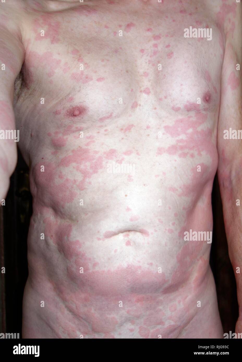 Man, 68 years old, with allergic reaction, skin rash, allergy, to insect repellent Baygon, Indonesia Stock Photo