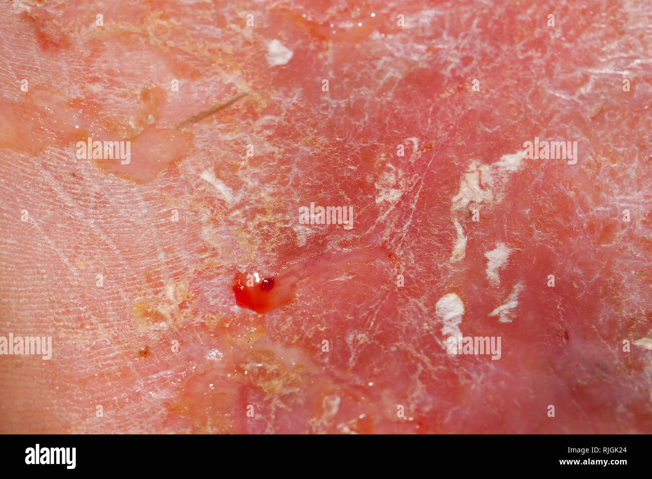 Acute Neurodermatitis respectively atopic eczema Stock Photo Alamy