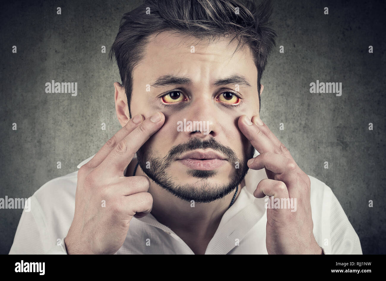 Hepatic disease. Sick man looking in a mirror has yellowish eyes as sign of possible liver infection or other disease. Stock Photo