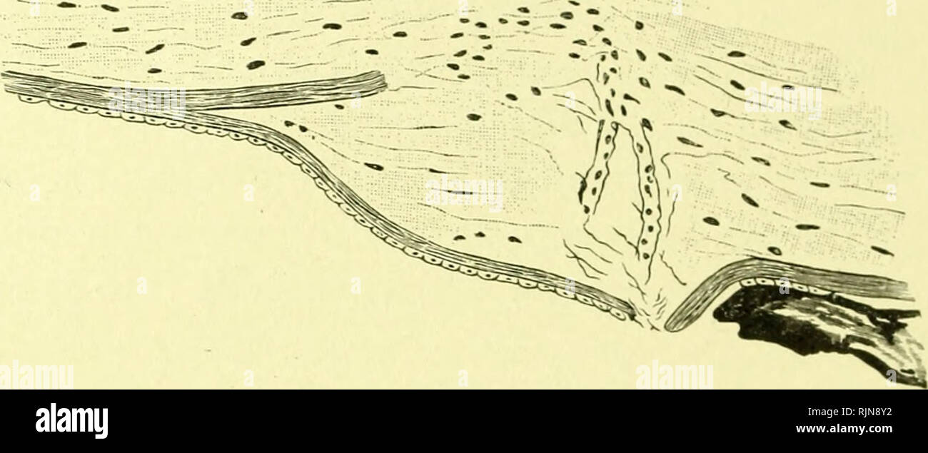 Keratitis Eye Stock Photos & Keratitis Eye Stock Images 