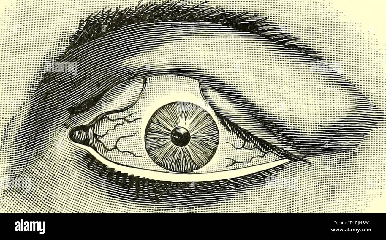 . Pathology and bacteriology [electronic resource]. Ophthalmology; Eye; Eye; Bacteriology; Ophthalmology; Eye; Bacteriology; Eye. COLOBOMA OF THE EYELID 131 The abnormality is frequently associated with other con- genital defects about the face, attributable to defective de- velopment in the line of the facial fissures, such as hare-lip,. Fig. 74.—Congenital coloboma of the upper eyelid in a boy aged two years. cleft-palate, macroglossia, supernumerary auricles, etc. Many of such defects are due to pressure caused by bands in the amnion. Some cases of coloboma of the eyelid may be. Please note Stock Photo
