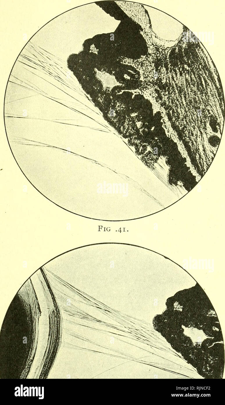 . Pathology and bacteriology [electronic resource]. Ophthalmology; Eye; Eye; Bacteriology; Ophthalmology; Eye; Bacteriology; Eye. COLOBOMA OF THE VITREOUS HUMOUR 69. Fig. 42. Figs. 41, 42.—Show the suspensory ligament of the lens in sections of a normal htiman eye. The foremost fibres shown in Fig. 42 are the orbiculo-antero- capsular fibres, the prolongation of which backwards to the non-plicated part of the ciliary body is shown in Fig. 41. The hindermost fibres shown in both figures are the orbiculo-posterio-capsular fibres. The cilio-equatorial fibres can be seen in Fig. 42 crossing the or Stock Photo