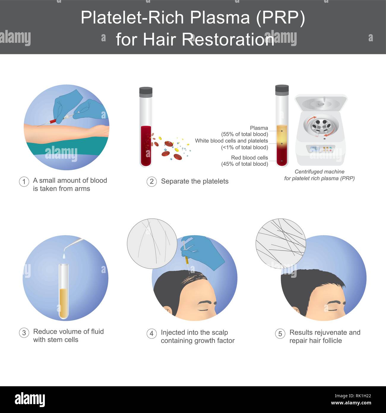 Stimulation of hair growth by using blood from service recipients through the process of separating platelet rich plasma, To be injected onto the scal Stock Vector