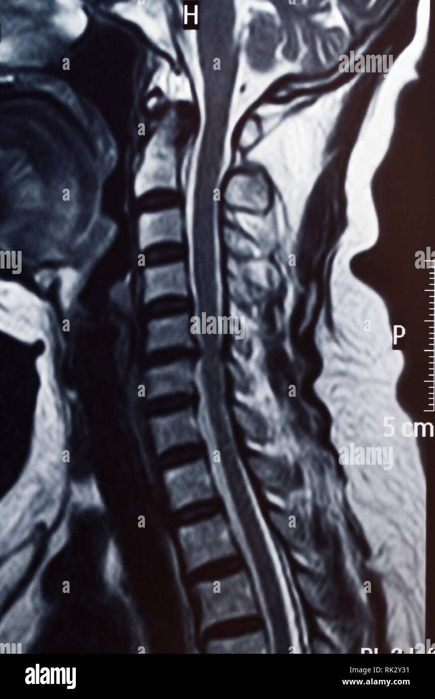 Human spine shadow hires stock photography and images Alamy