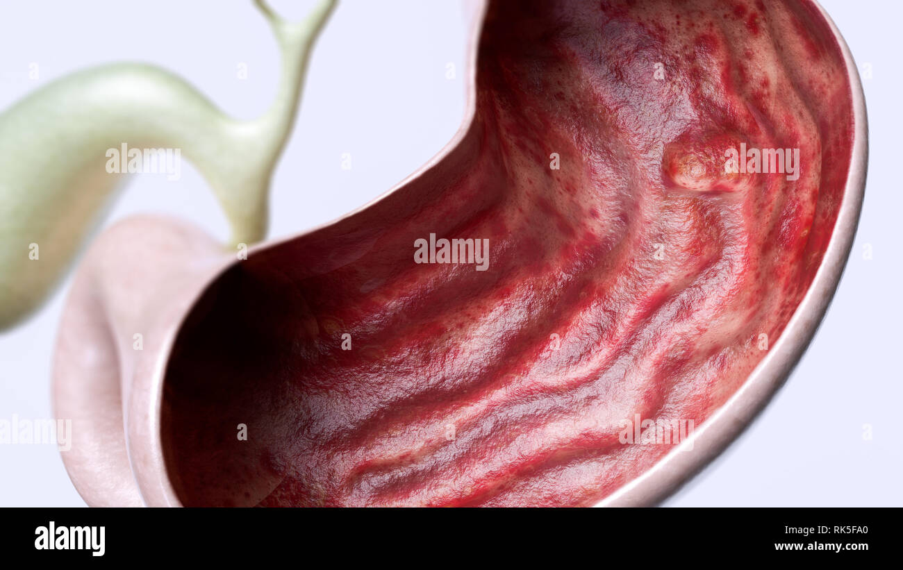 Stomach ulcer stage 2 of 3 - high degree of detail - 3D Rendering Stock Photo