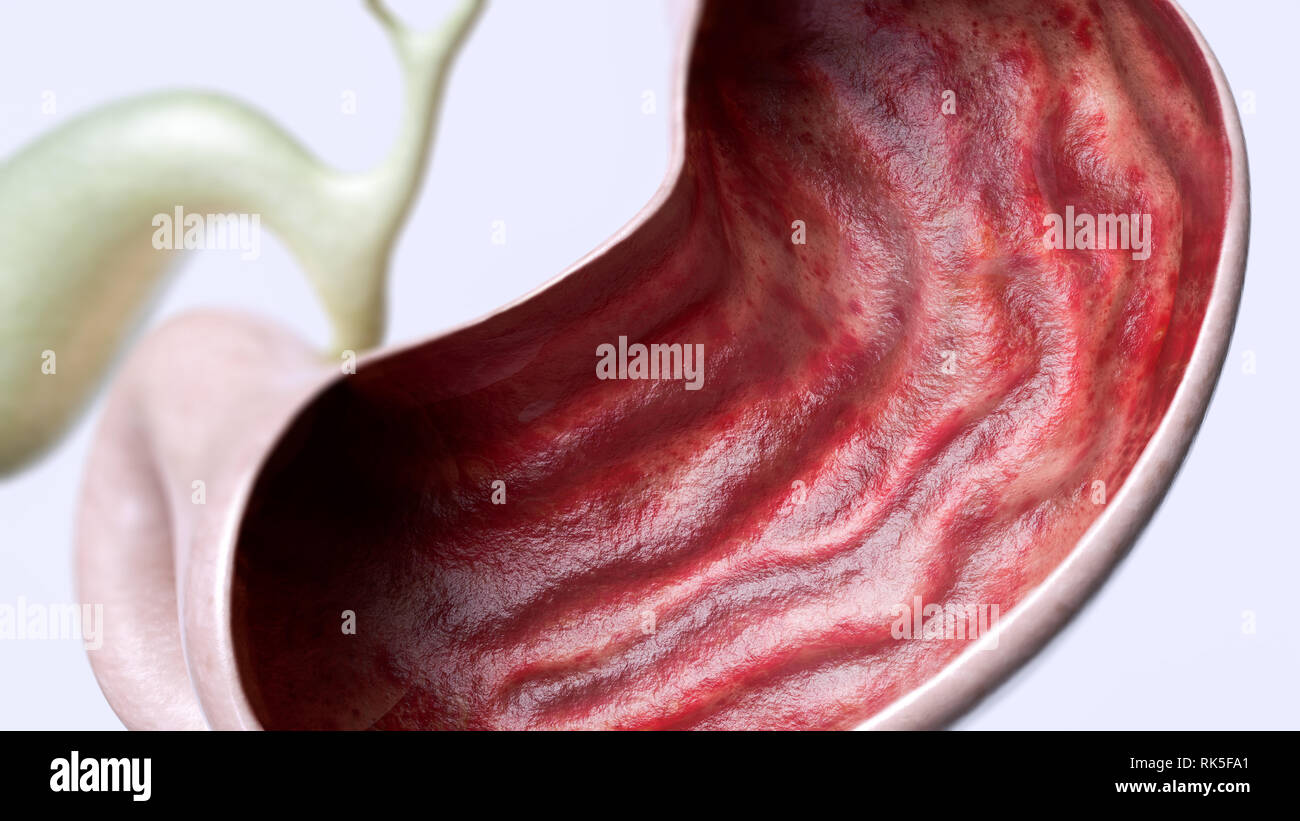 Stomach ulcer stage 1 of 3 - high degree of detail - 3D Rendering Stock Photo