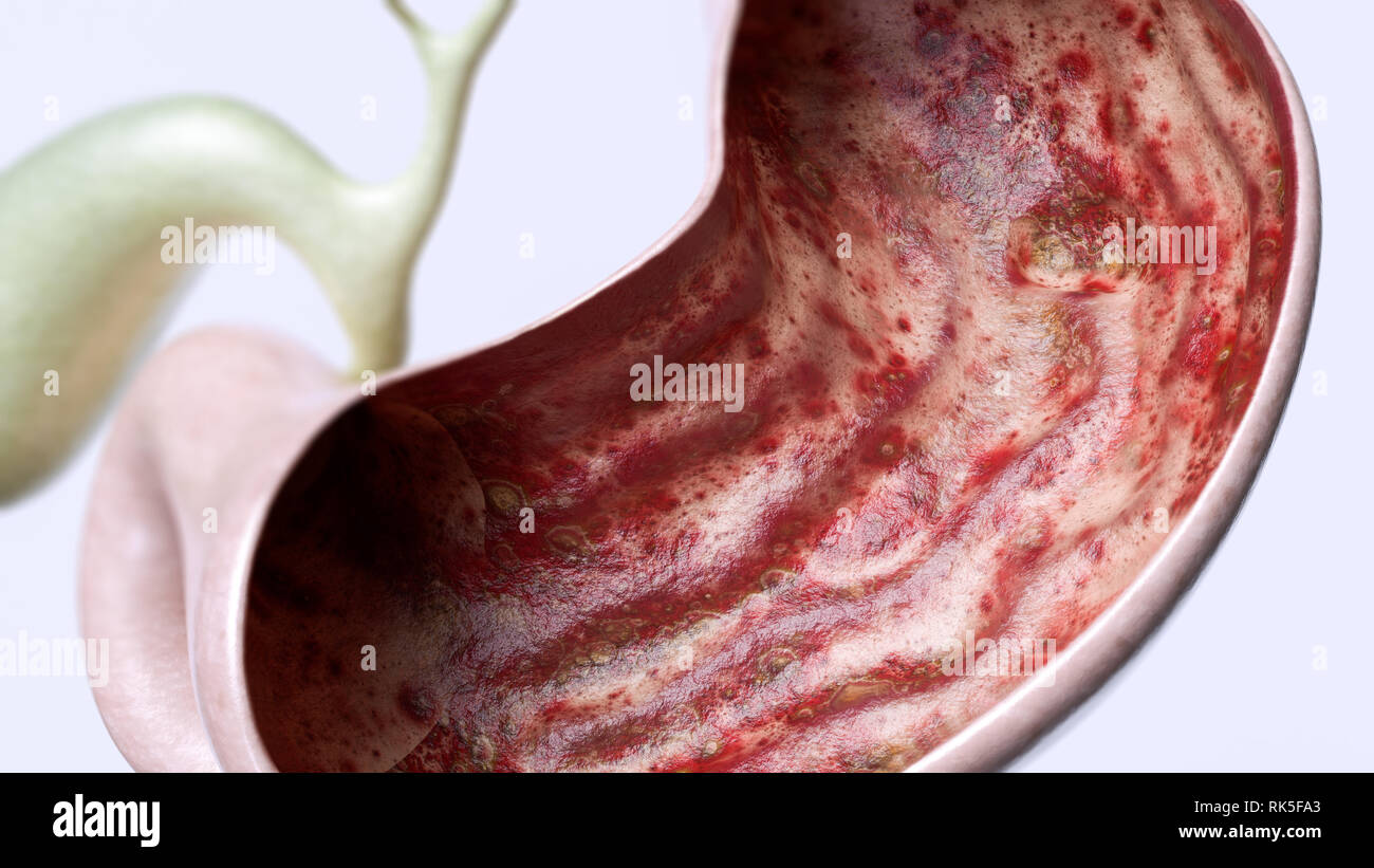 Stomach ulcer stage 3 of 3 - high degree of detail - 3D Rendering Stock Photo