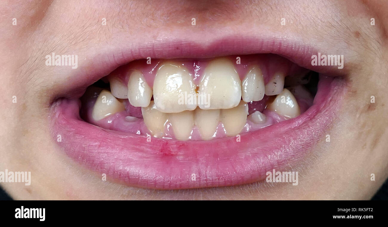 oral and dental health, tartar and black spots on the teeth Stock Photo