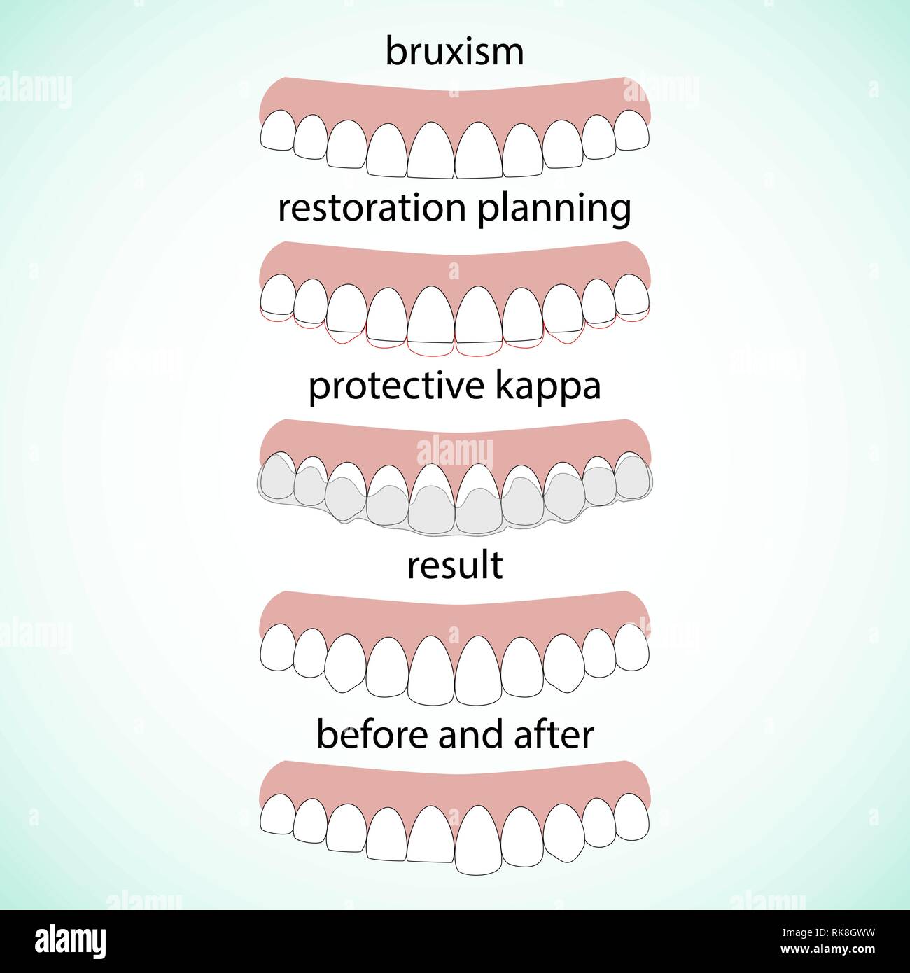 Layout attrition Bruxism teeth illustration vector. Erased teeth.  Restoration of teeth. Protective kappa. Dental concept Stock Vector Image &  Art - Alamy
