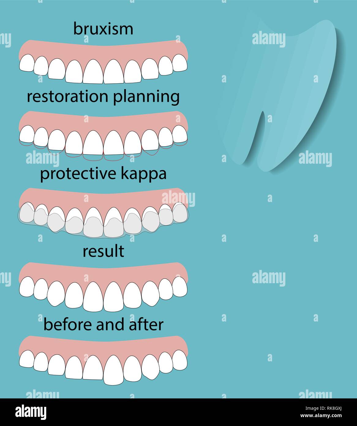Layout Bruxism teeth illustration vector. Erased teeth. Restoration of teeth. Protective kappa. concept Stock Image & Art Alamy