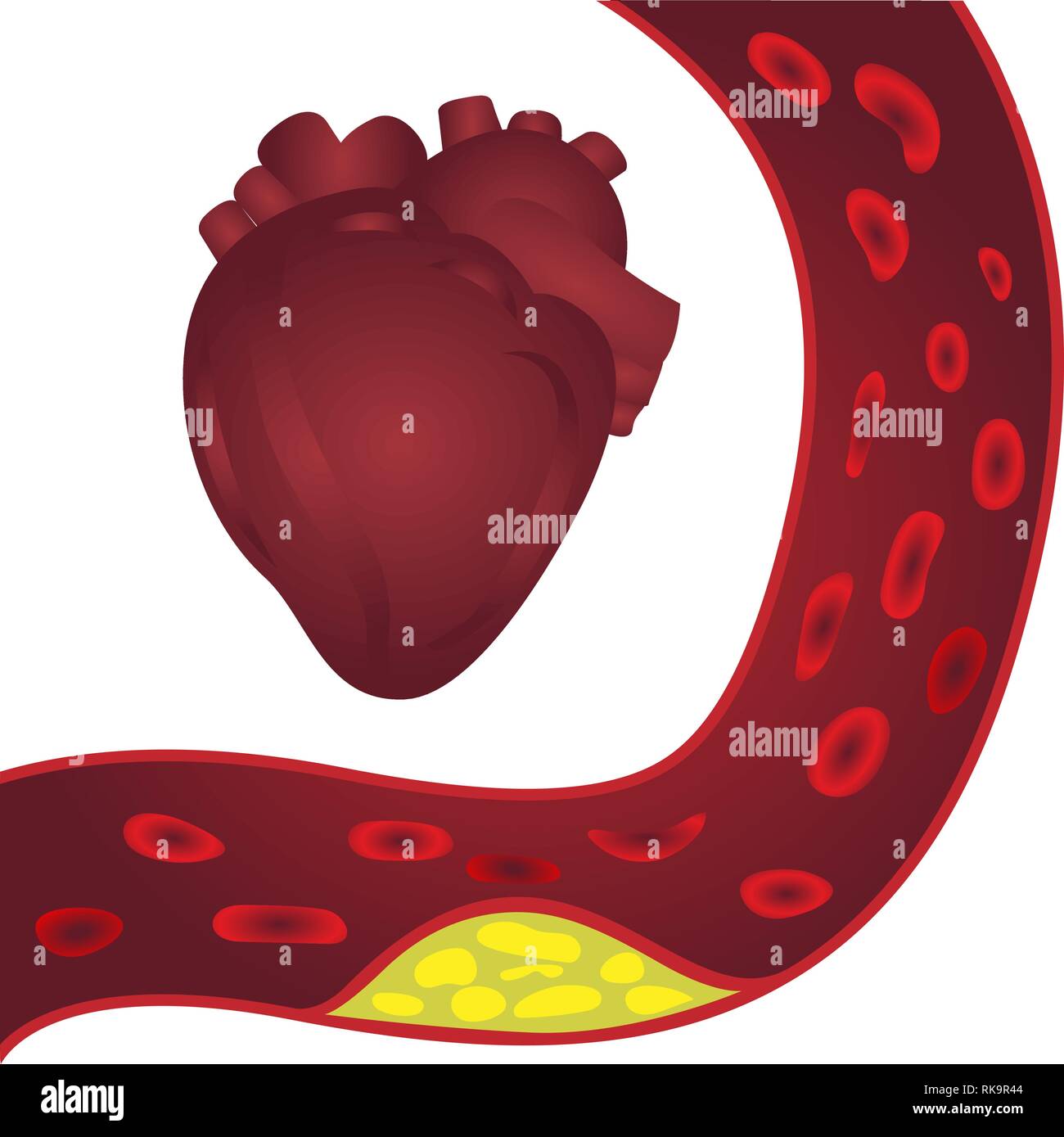 Cholesterol Plaque In Artery And A Heart Atherosclerosis Vector Illustration On A White 9588