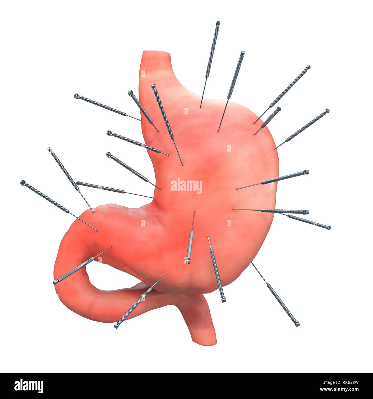 Human stomach with acupuncture needles. Acupuncture treatment of