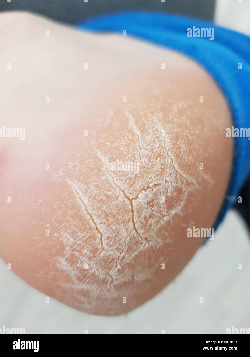 The Heel Of Foot With Bad Skin Is Covered Stock Photo Alamy