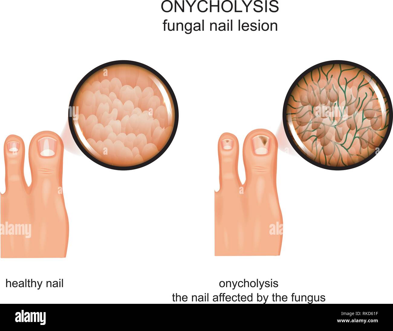 vector illustration of fungal nail lesion. infection, onycholysis Stock Vector