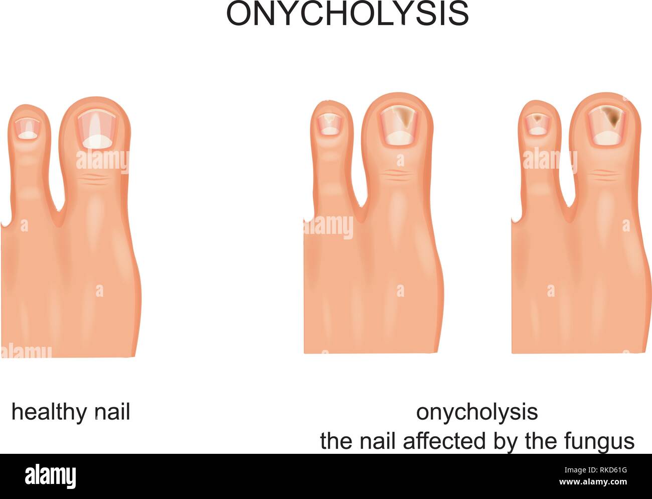 vector illustration of fungal nail infection, onycholysis Stock Vector