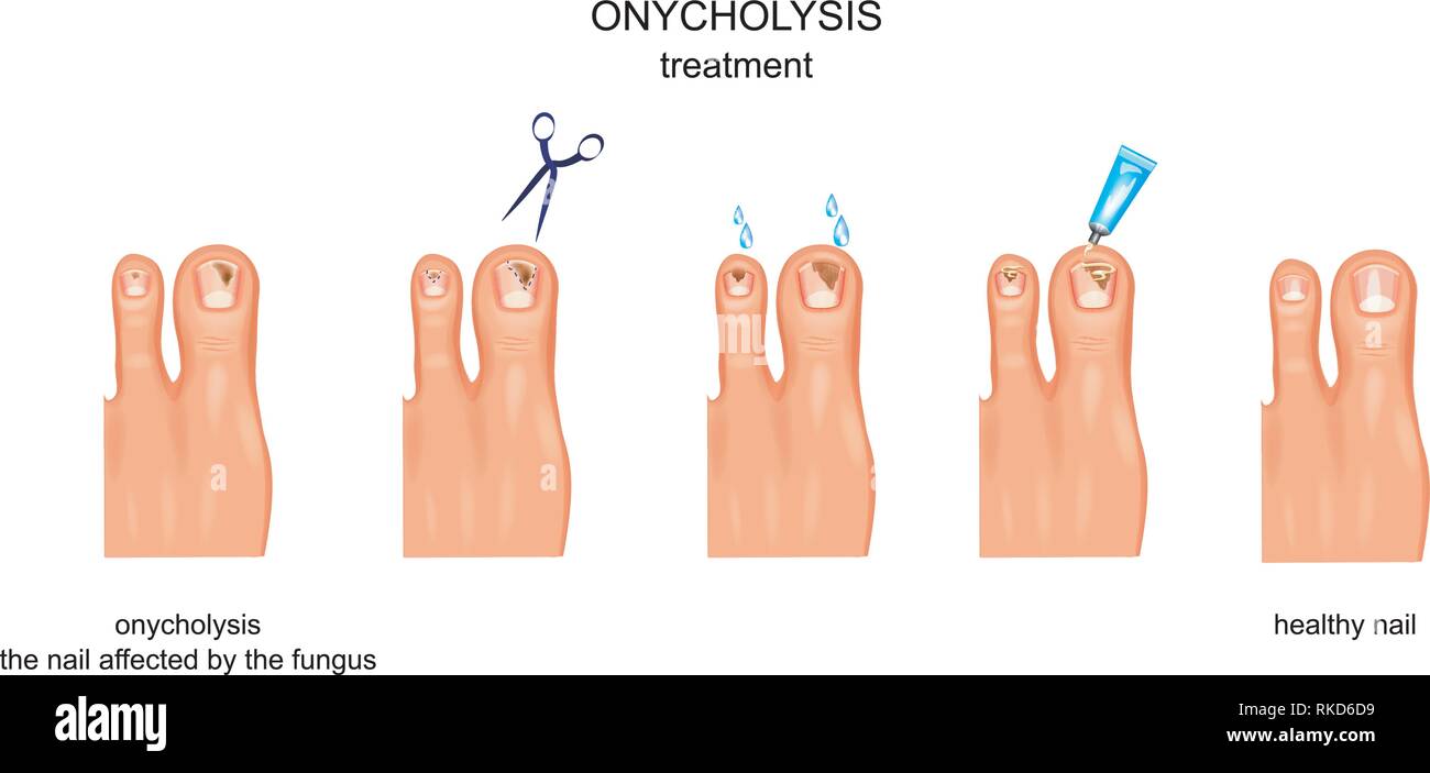 vector illustration of onycholysis, fungal nail infection, treatment Stock Vector