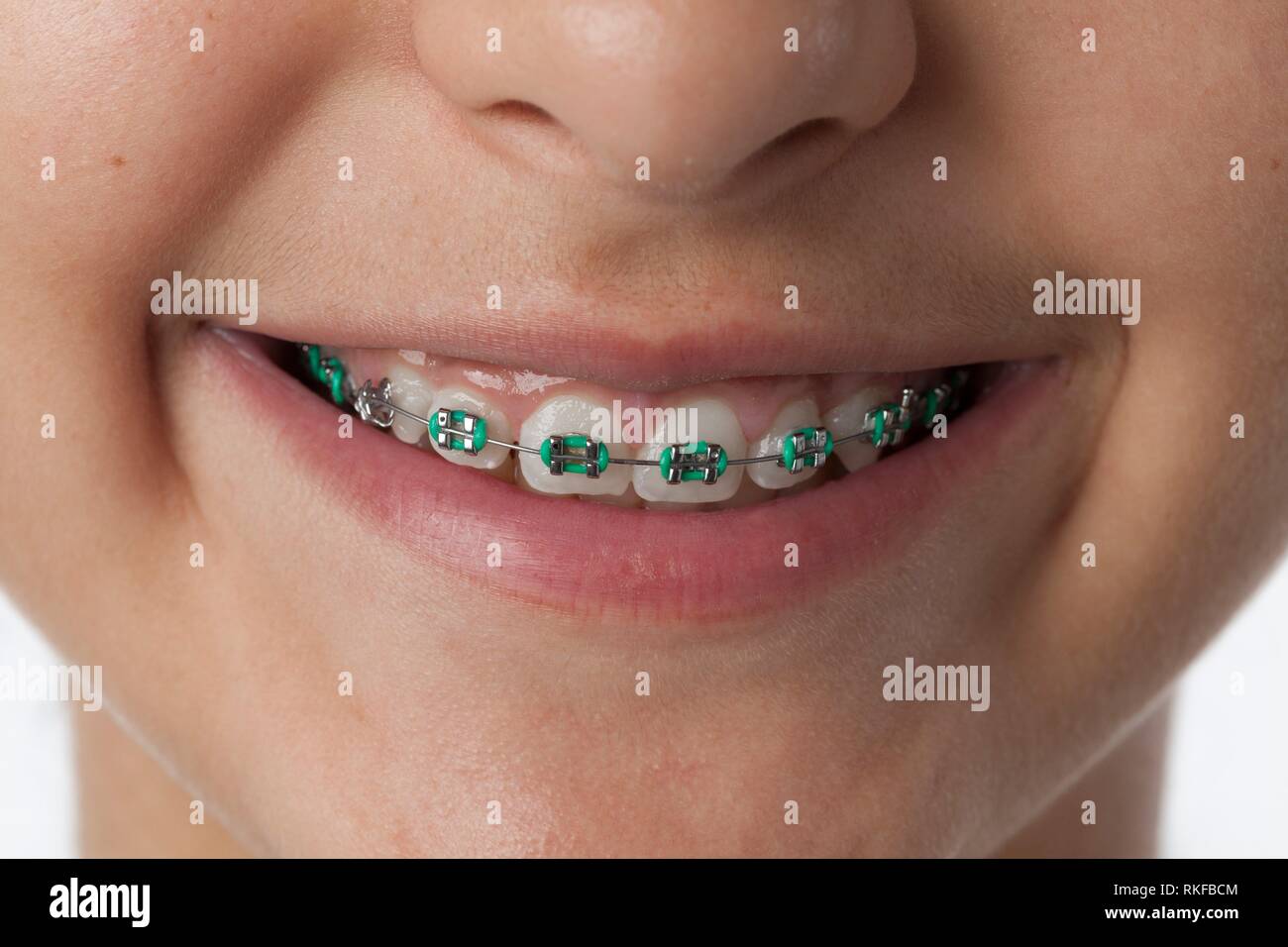 Close up of dental braces in the mouth and on the teeth of a teenage girl. Stock Photo