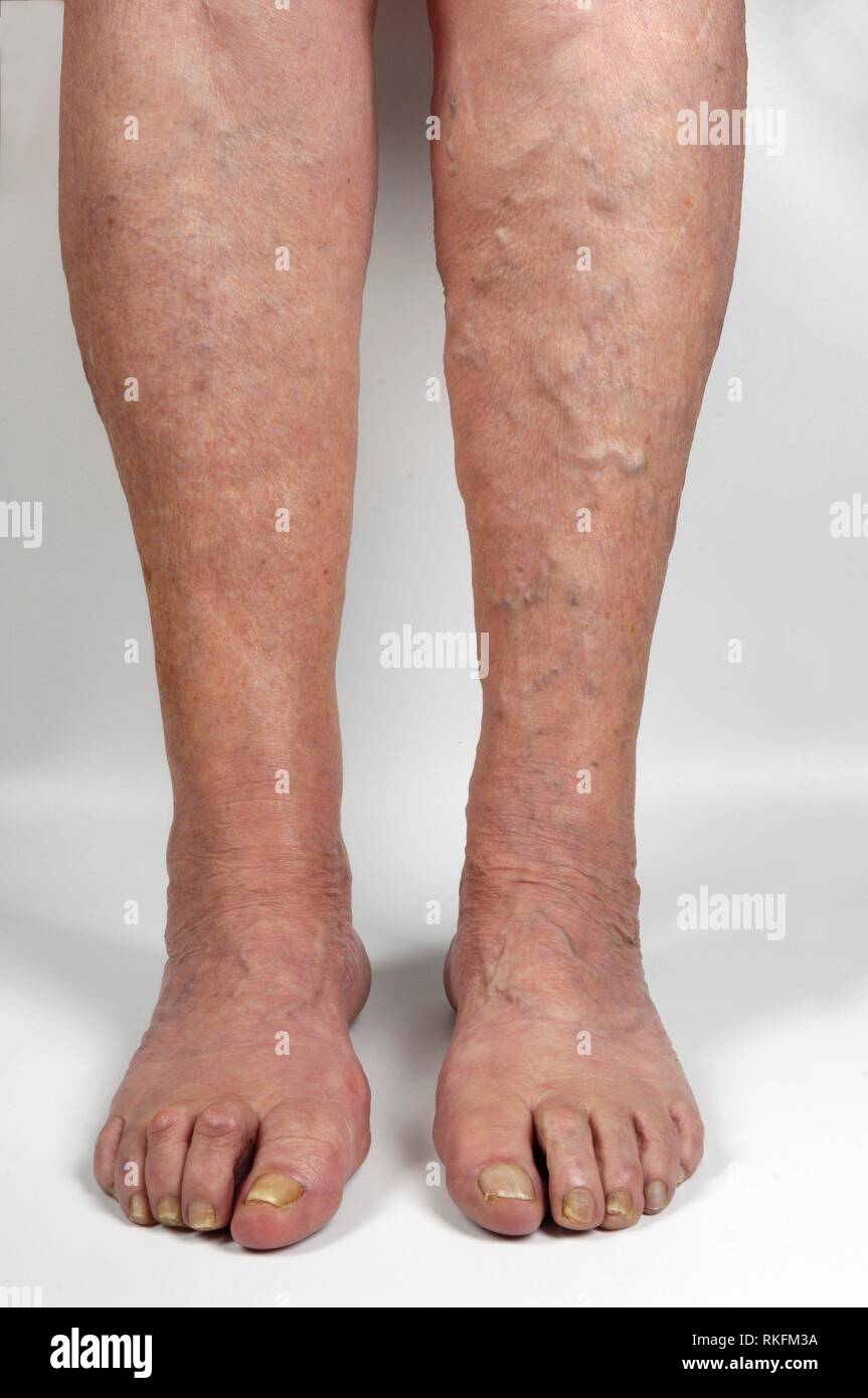 varicose veins in the leg of a woman,. Stock Photo