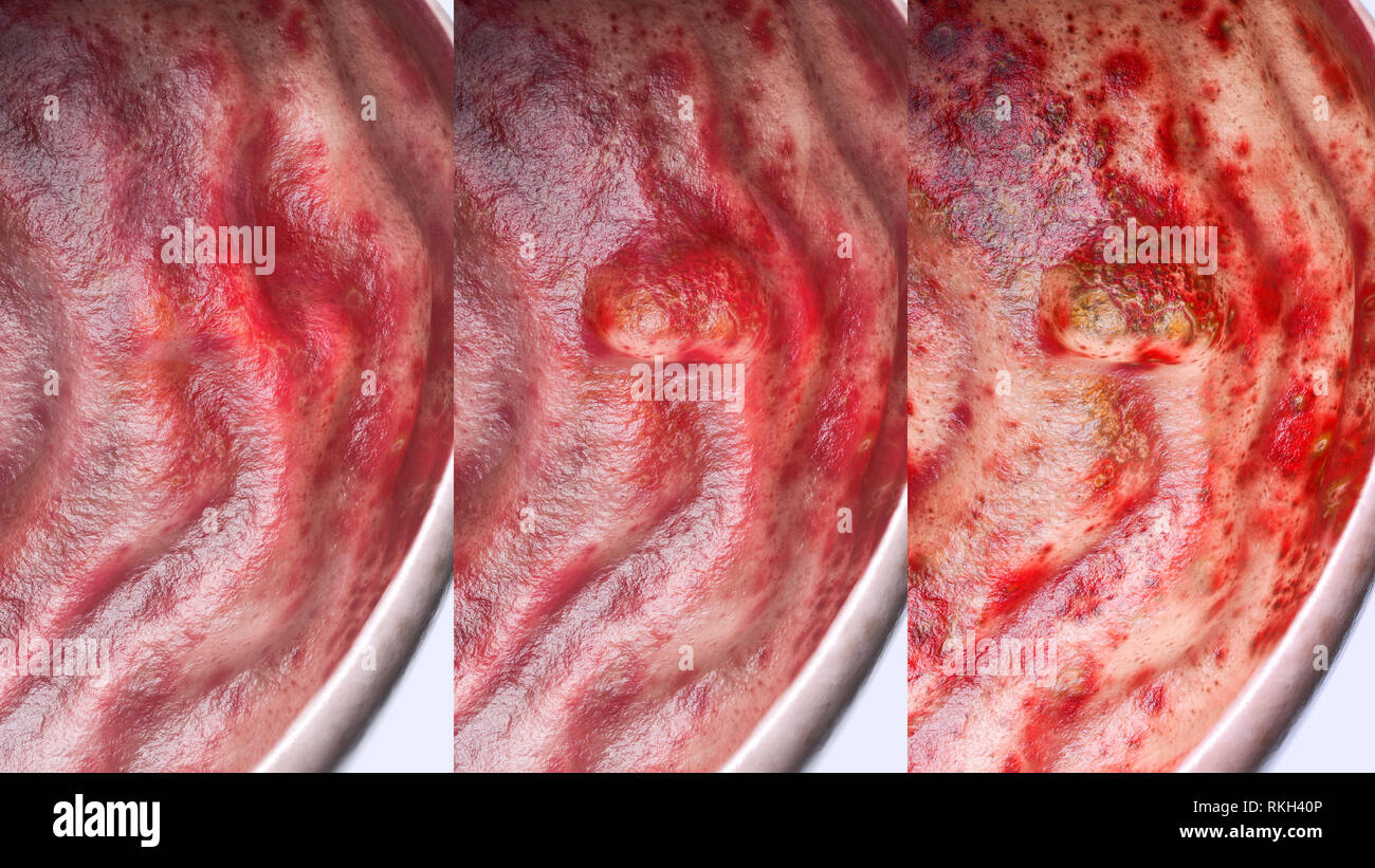 Gastric ulcer in various stages- high degree of detail - 3D Rendering Stock Photo