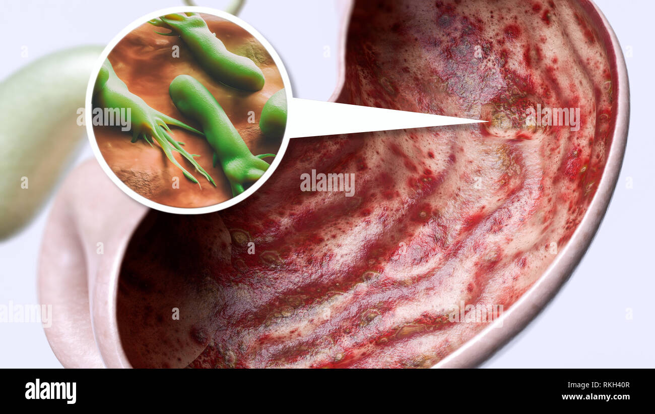 Gastric ulcer by Helicobacter pylori - high degree of detail - 3D Rendering Stock Photo