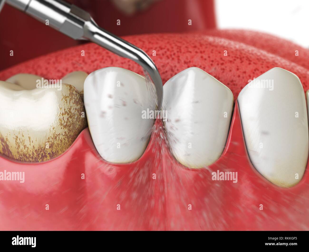 Professional teeth cleaning. Ultrasonic teeth cleaning machine delete