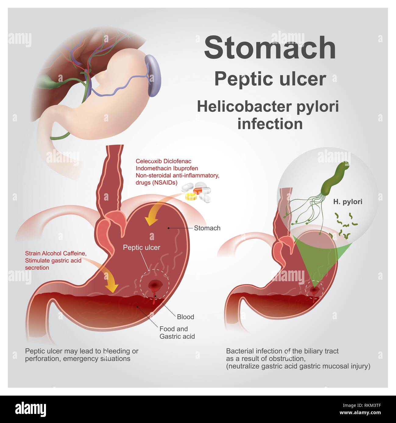 pressure-ulcer-hospital-cut-out-stock-images-pictures-alamy