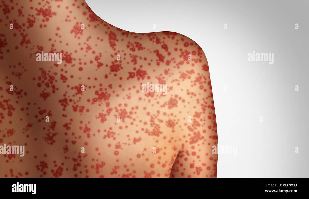 Measles concept as a deadly outbreak immunize disease and viral illness as a contagious chickenpox or a skin rash in a 3D illustration style. Stock Photo