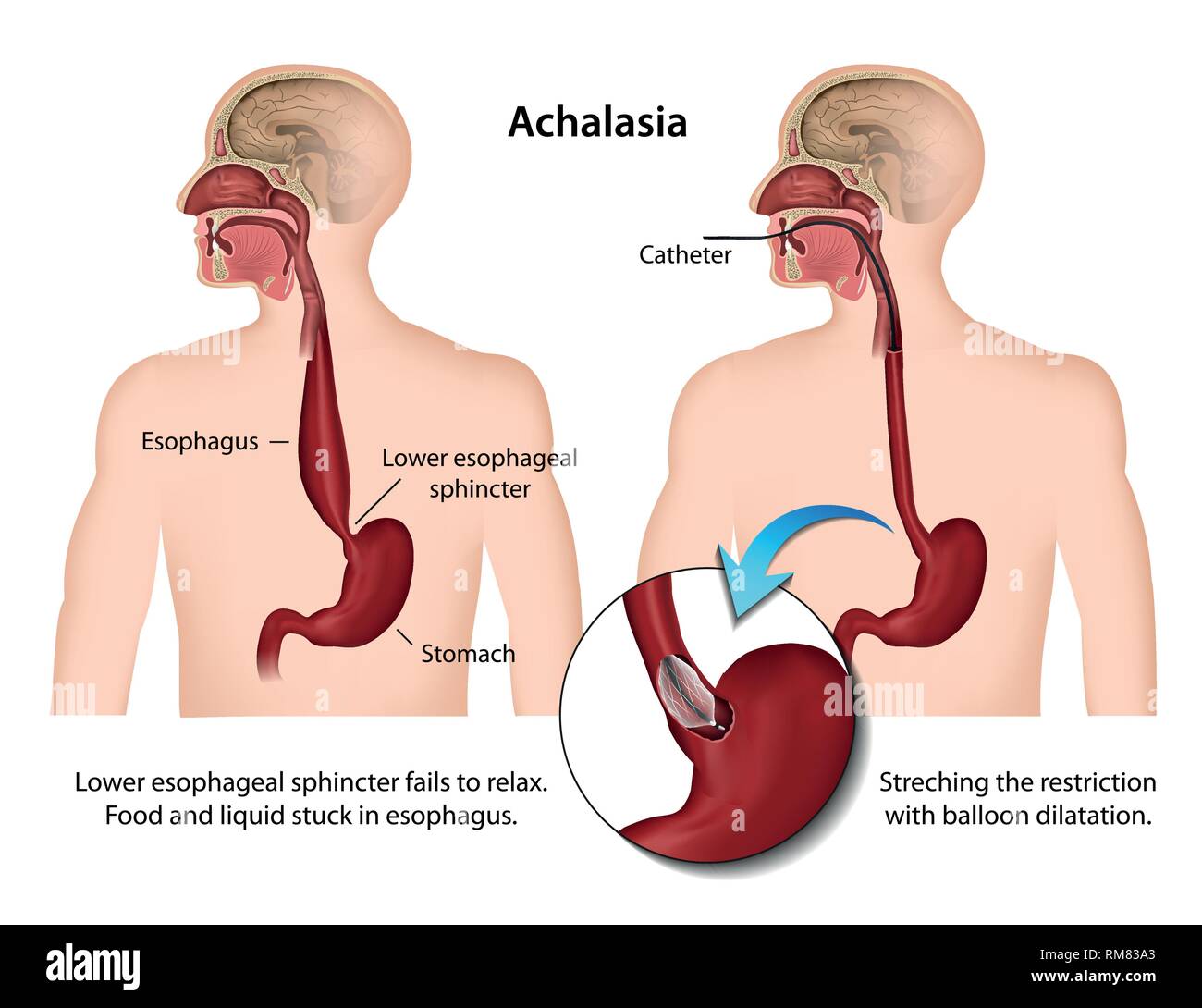 Achalasia of the esophagus 3d medical vector illustration Stock Vector