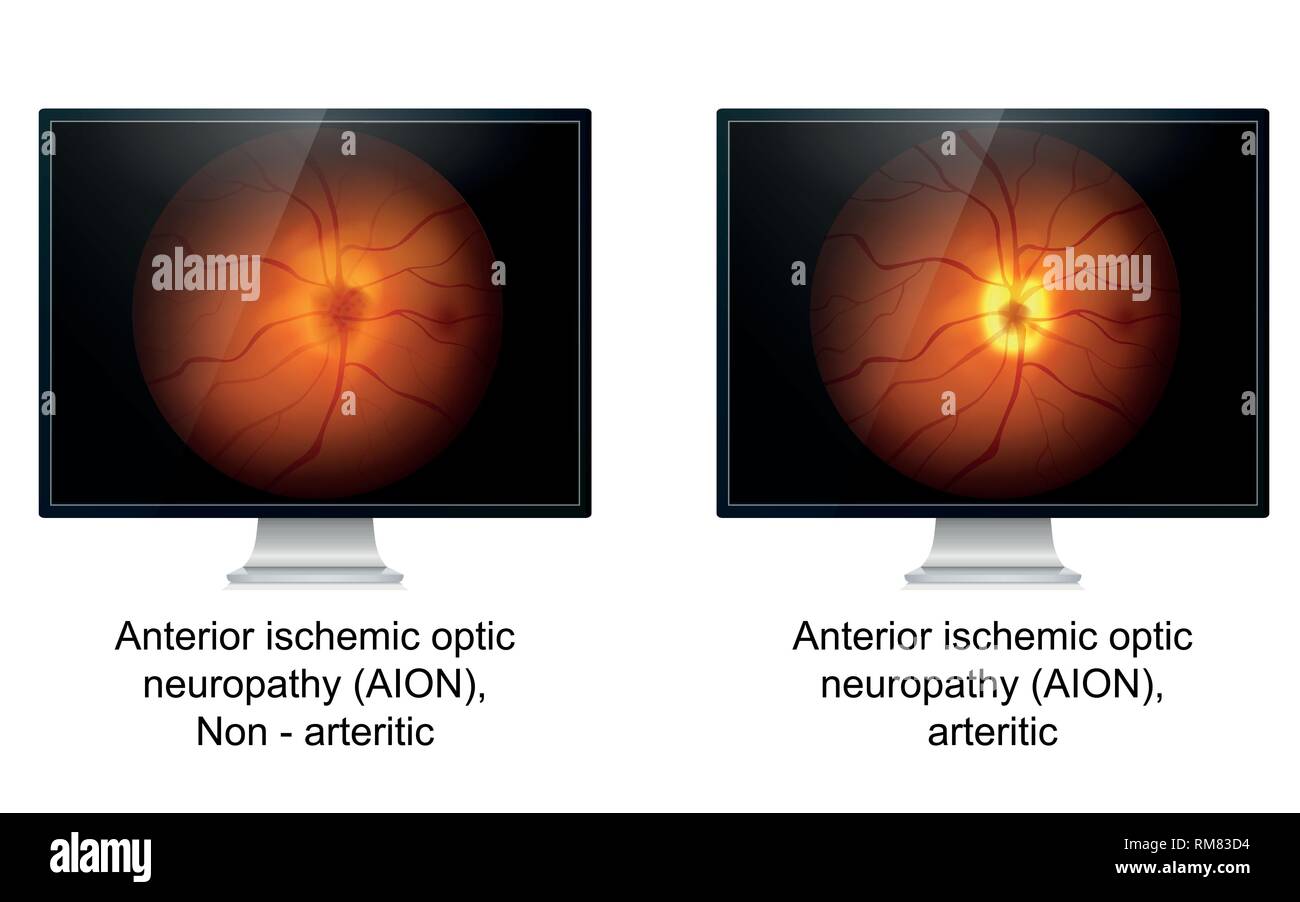 Optic ischemic neuropathy medical vector illustration Stock Vector